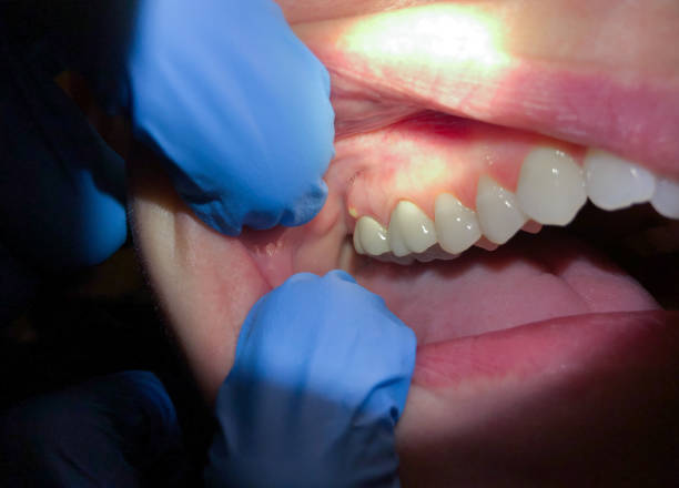 Best Emergency Tooth Extraction in Upper Ack, NY